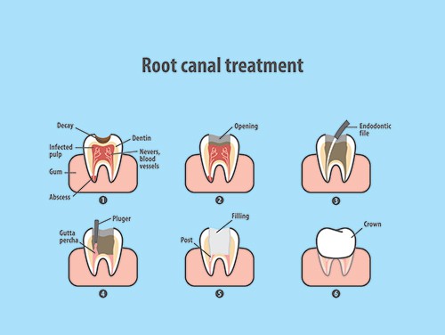 Root Canal Therapy