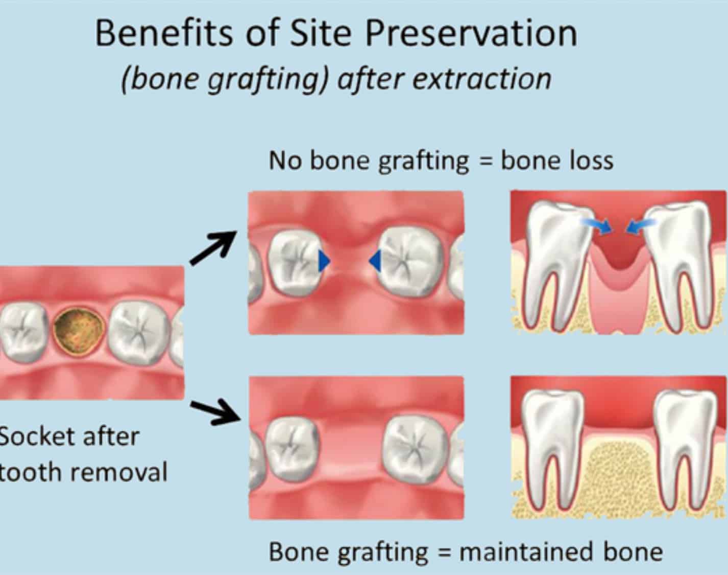 Oral Surgery – Bone grafts