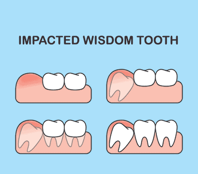 Wisdom Teeth Extractions