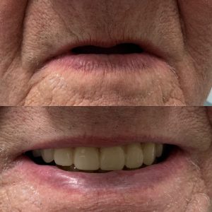 FULL DENTURE IN DALLAS, GA