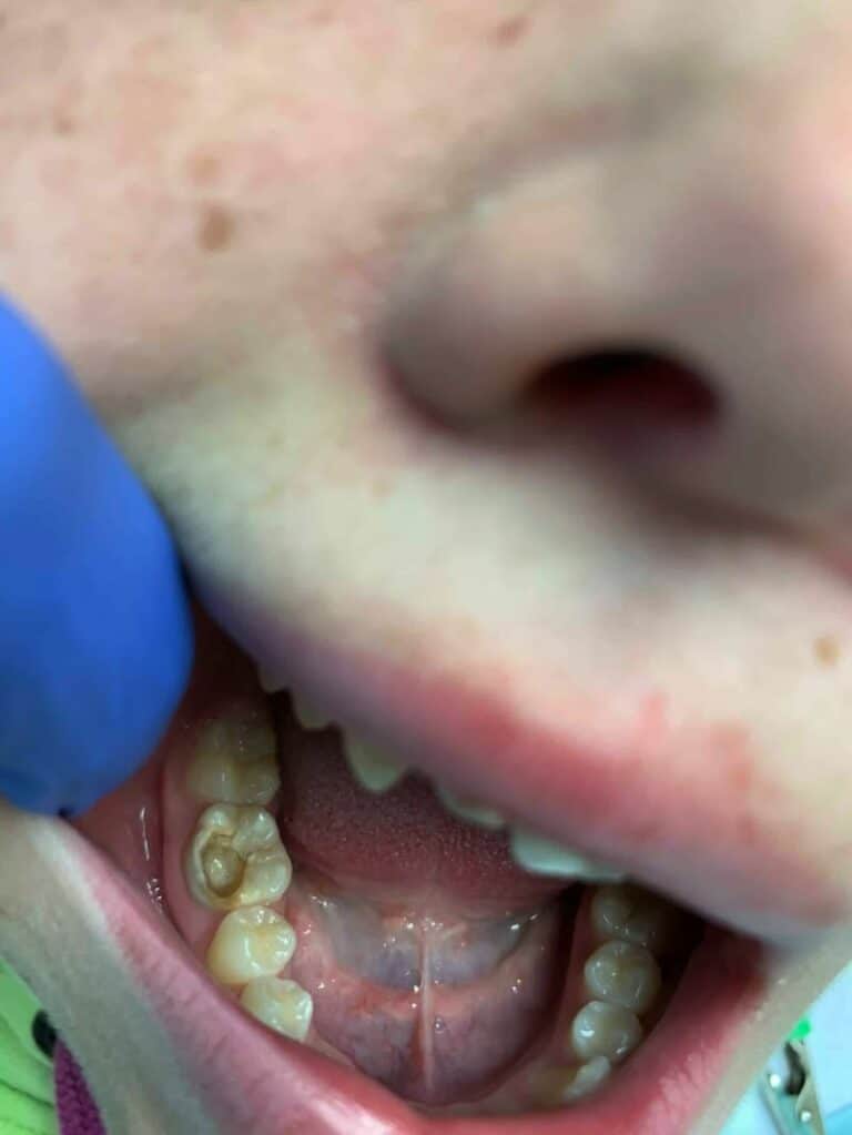 TREATMENT AND TOOTH FILLING