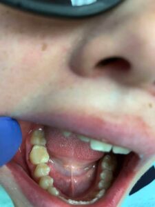 TREATMENT AND TOOTH FILLING AFTER