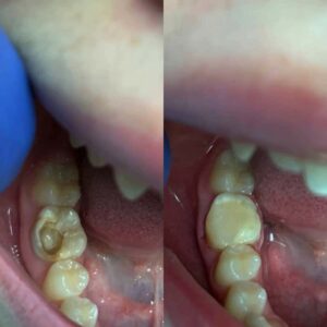 TREATMENT AND TOOTH FILLING. BEFORE AND AFTER